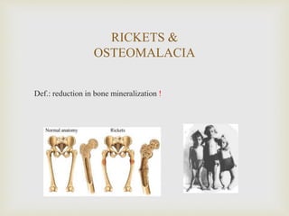 RICKETS &
OSTEOMALACIA
Def.: reduction in bone mineralization !
 