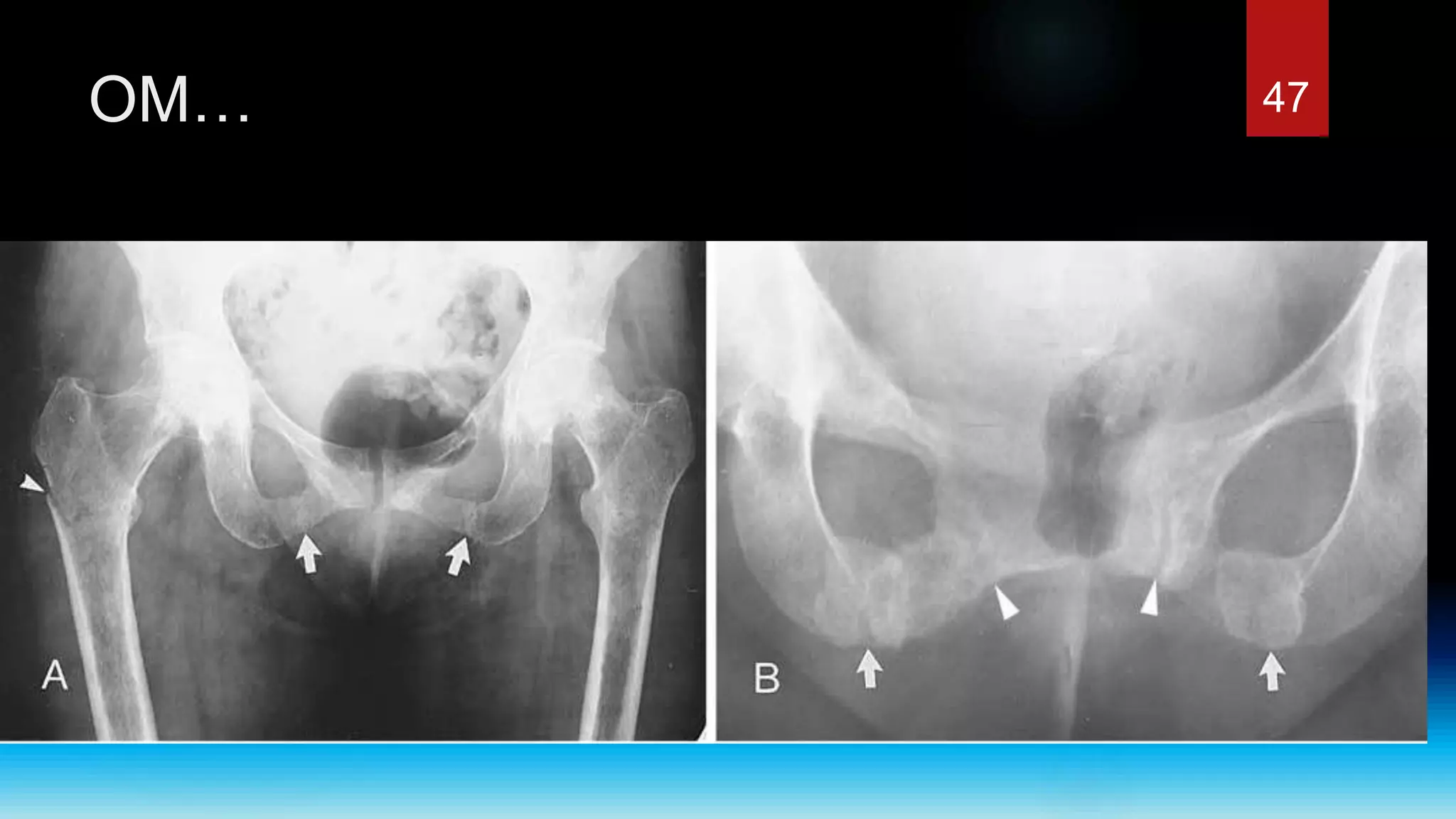 Rickets and osteomalacia | PPTX