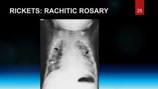 Rickets and osteomalacia | PPTX