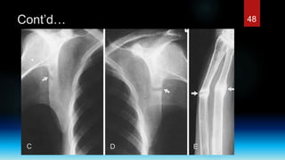 Rickets and osteomalacia | PPTX