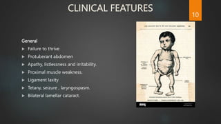 CLINICAL FEATURES
General
 Failure to thrive
 Protuberant abdomen
 Apathy, listlessness and irritability.
 Proximal muscle weakness.
 Ligament laxity
 Tetany, seizure , laryngospasm.
 Bilateral lamellar cataract.
10
 