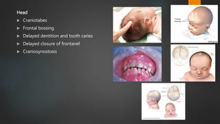 Head
 Craniotabes
 Frontal bossing
 Delayed dentition and tooth caries
 Delayed closure of frontanel
 Craniosynostosis
11
 