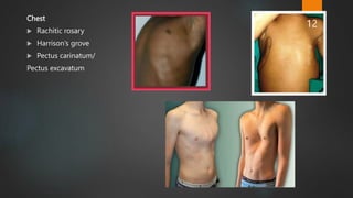 Chest
 Rachitic rosary
 Harrison’s grove
 Pectus carinatum/
Pectus excavatum
12
 