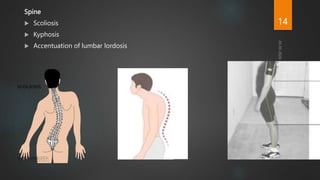 Spine
 Scoliosis
 Kyphosis
 Accentuation of lumbar lordosis
14
 