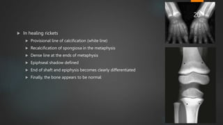  In healing rickets
 Provisional line of calcification (white line)
 Recalcification of spongiosa in the metaphysis
 Dense line at the ends of metaphysis
 Epiphseal shadow defined
 End of shaft and epiphysis becomes clearly differentiated
 Finally, the bone appears to be normal
20
 