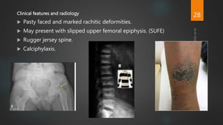 Clinical features and radiology
 Pasty faced and marked rachitic deformities.
 May present with slipped upper femoral epiphysis. (SUFE)
 Rugger jersey spine.
 Calciphylaxis.
28
 