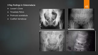 X Ray findings in Osteomalacia
 Looser’s Zone
 Triradiate Pelvis
 Protrusio acetabula
 Codfish Vertebrae
48
 
