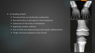 Rickets and Osteomalacia, Orthopaedics.pptx