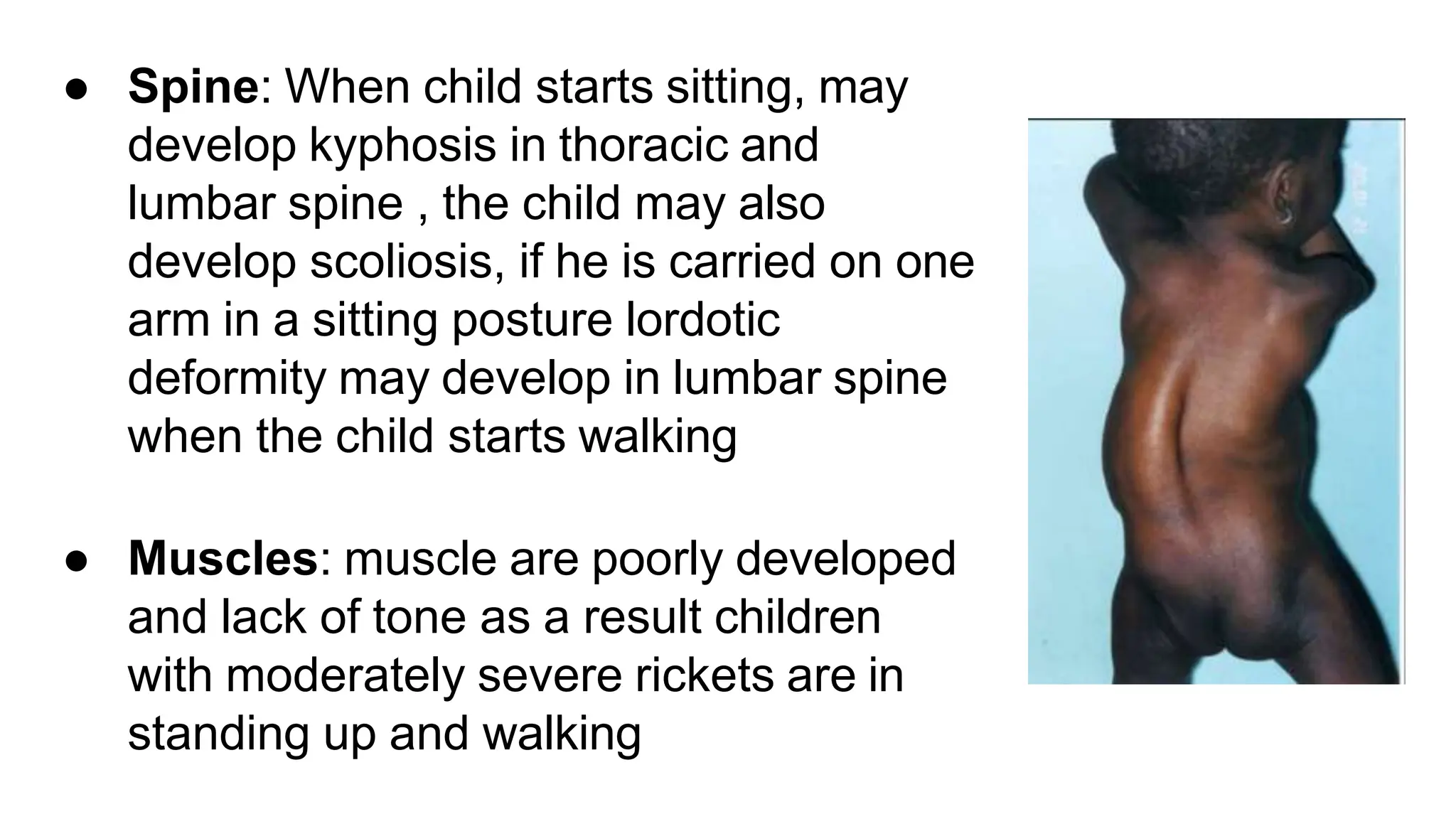 Rickets and osteomalacia presentation for postgarduate in orthopaedics ...