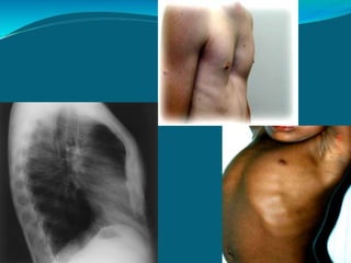 Rickets and osteomalacia | PPTX