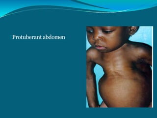 Rickets and osteomalacia | PPTX