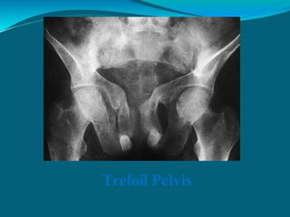 Rickets and osteomalacia | PPTX