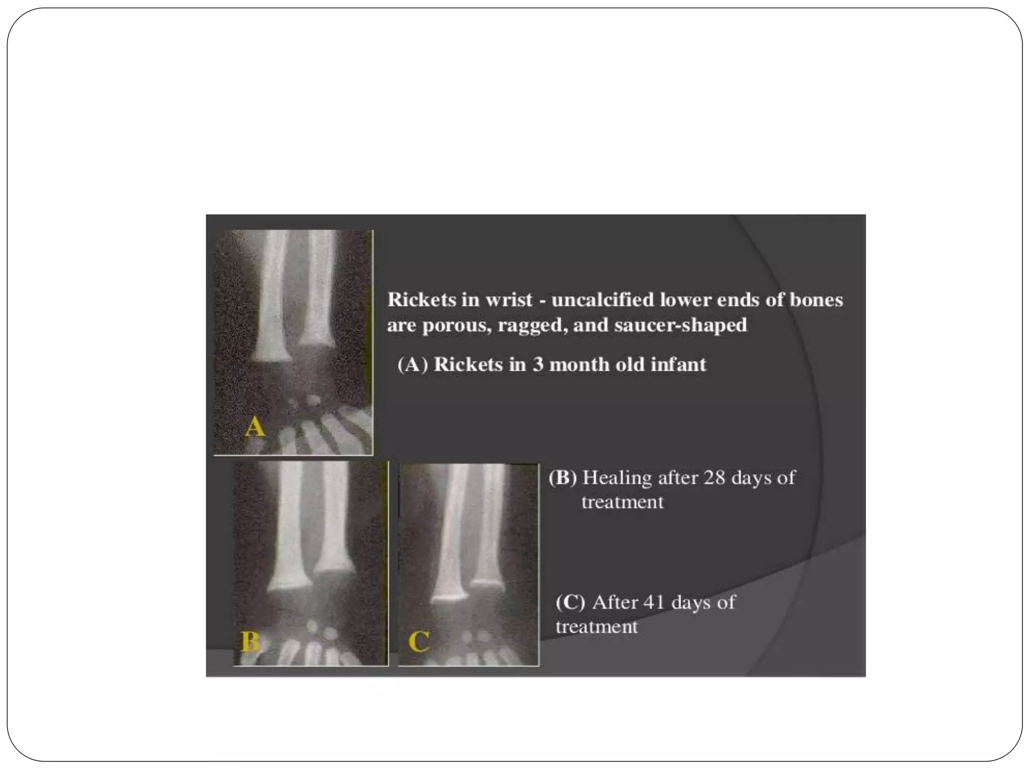 Rickets and osteomalacia | PPTX