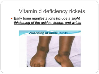 Vitamin d deficiency rickets
 Early bone manifestations include a slight
thickening of the ankles, knees, and wrists
 