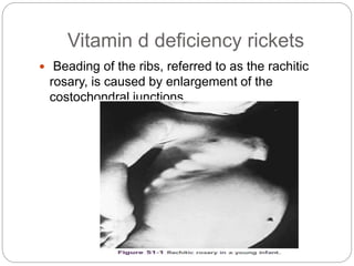 Vitamin d deficiency rickets
 Beading of the ribs, referred to as the rachitic
rosary, is caused by enlargement of the
costochondral junctions.
 
