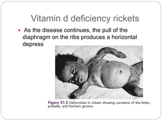 Vitamin d deficiency rickets
 As the disease continues, the pull of the
diaphragm on the ribs produces a horizontal
depression known as Harrison’s groove
 