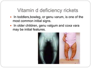 Vitamin d deficiency rickets
 In toddlers,bowleg, or genu varum, is one of the
most common initial signs.
 In older children, genu valgum and coxa vara
may be initial features.
 