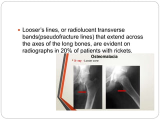  Looser’s lines, or radiolucent transverse
bands(pseudofracture lines) that extend across
the axes of the long bones, are evident on
radiographs in 20% of patients with rickets.
 