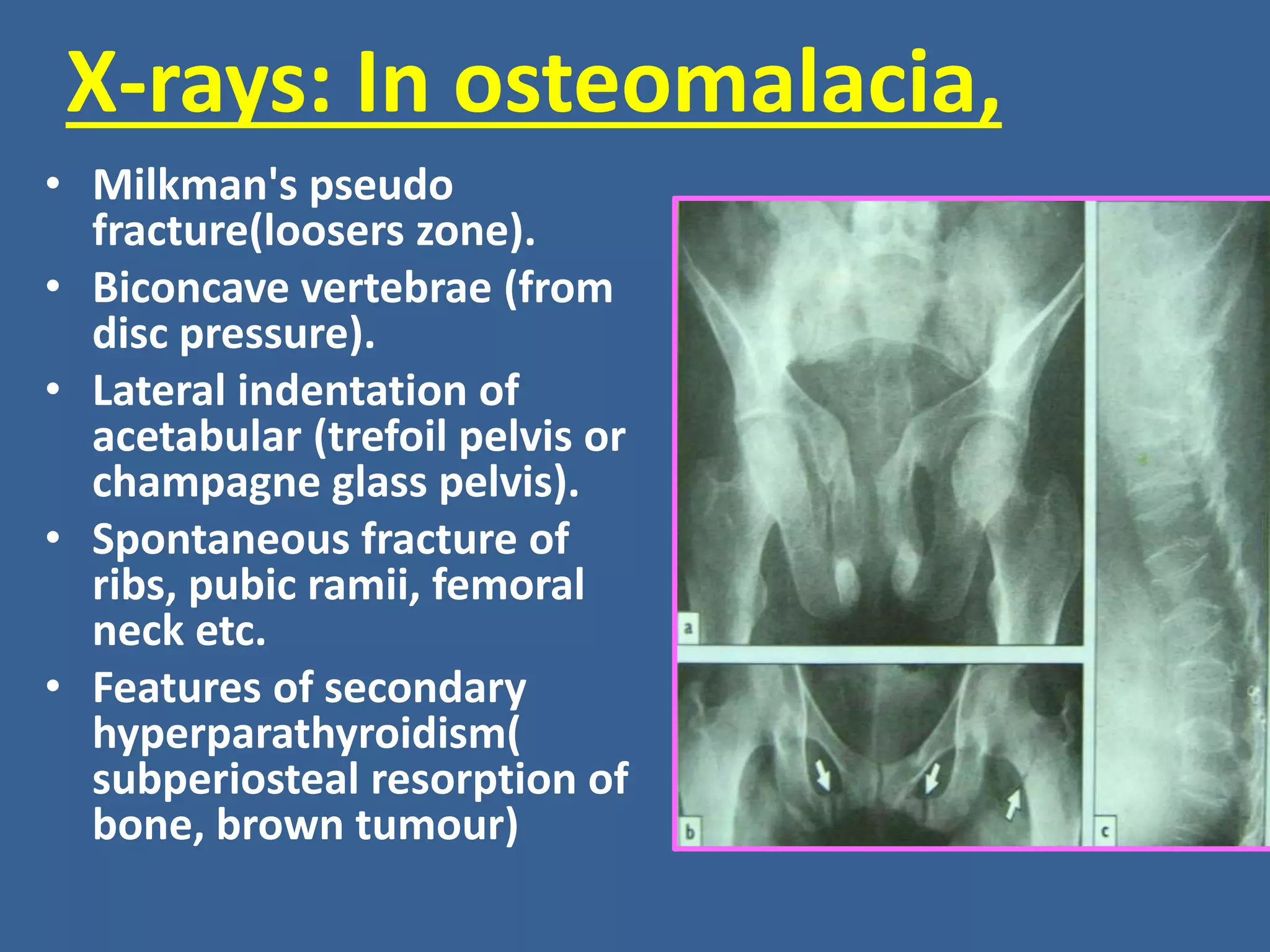 Rickets and osteomalacia,ppt | PPTX
