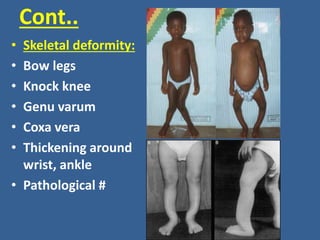 Cont..
• Skeletal deformity:
• Bow legs
• Knock knee
• Genu varum
• Coxa vera
• Thickening around
wrist, ankle
• Pathological #
 