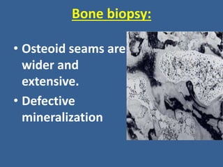 Bone biopsy:
• Osteoid seams are
wider and
extensive.
• Defective
mineralization
 