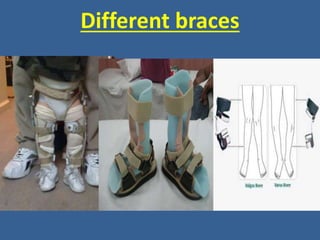 Different braces
 