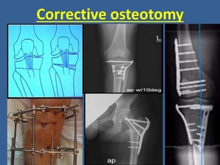 Corrective osteotomy
 
