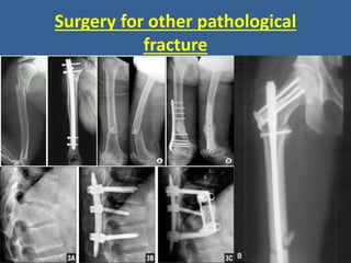 Surgery for other pathological
fracture
 