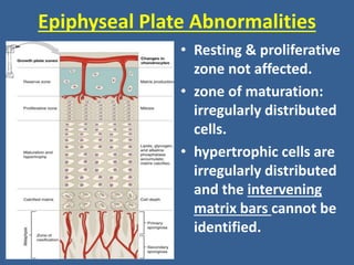 Epiphyseal Plate Abnormalities
• Resting & proliferative
zone not affected.
• zone of maturation:
irregularly distributed
cells.
• hypertrophic cells are
irregularly distributed
and the intervening
matrix bars cannot be
identified.
 