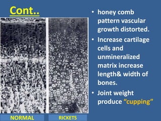 Cont..
NORMAL RICKETS
• honey comb
pattern vascular
growth distorted.
• Increase cartilage
cells and
unmineralized
matrix increase
length& width of
bones.
• Joint weight
produce “cupping”
 