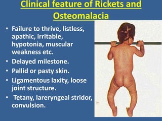 Clinical feature of Rickets and
Osteomalacia
• Failure to thrive, listless,
apathic, irritable,
hypotonia, muscular
weakness etc.
• Delayed milestone.
• Pallid or pasty skin.
• Ligamentous laxity, loose
joint structure.
• Tetany, lareryngeal stridor,
convulsion.
 