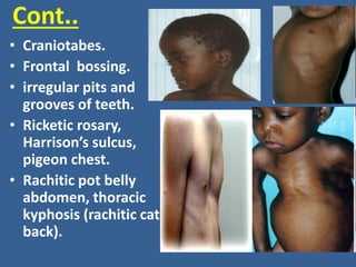 Cont..
• Craniotabes.
• Frontal bossing.
• irregular pits and
grooves of teeth.
• Ricketic rosary,
Harrison’s sulcus,
pigeon chest.
• Rachitic pot belly
abdomen, thoracic
kyphosis (rachitic cat
back).
 