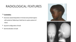 rickets class saurabh.presentation management | PPTX