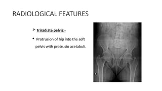 rickets class saurabh.presentation management | PPTX