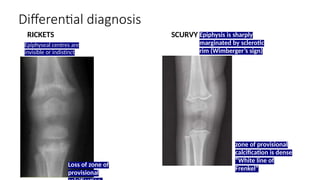 rickets class saurabh.presentation management | PPTX