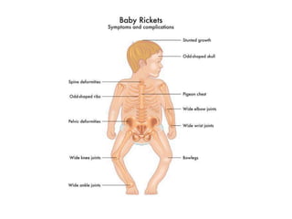 RICKETS.pptx
