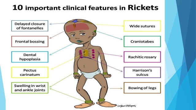 Mervin Rickets Rickets G1 saman and mina nephrology.pptx