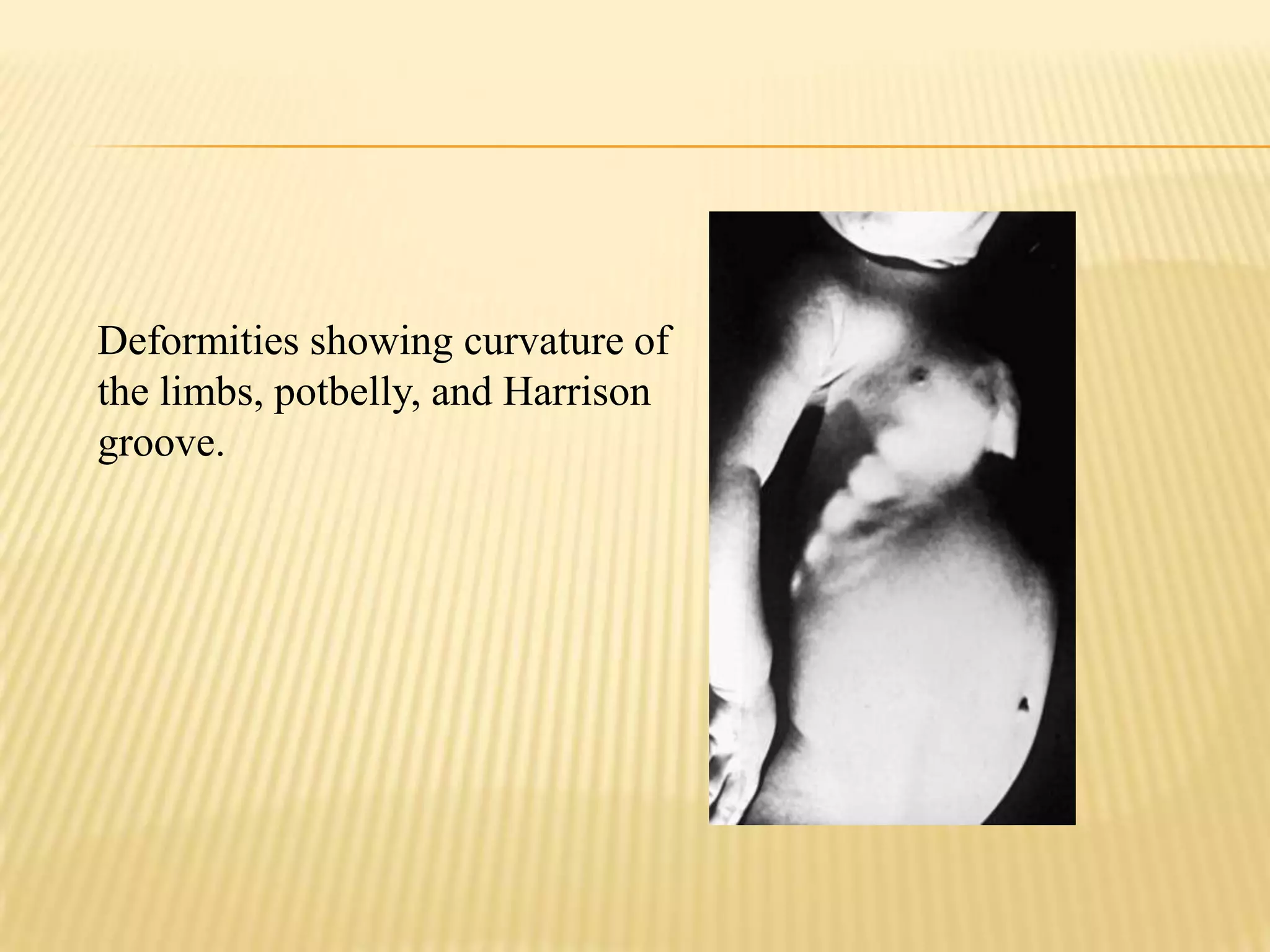 Rickets in children | PPTX