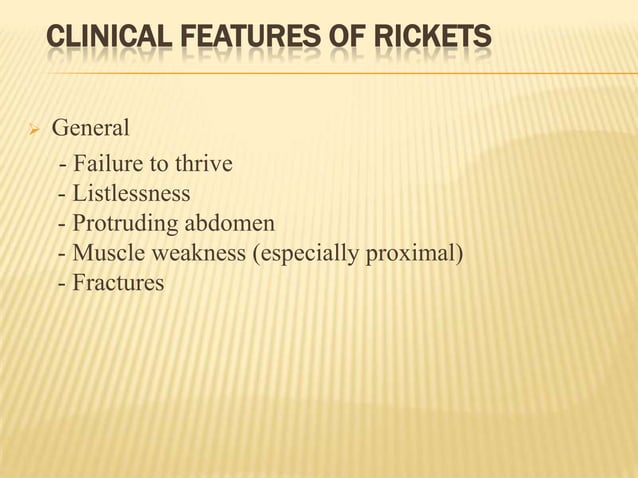 Rickets in children | PPTX