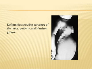 Deformities showing curvature of
the limbs, potbelly, and Harrison
groove.
 