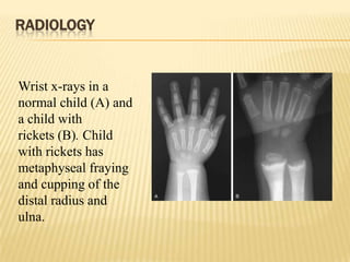 RADIOLOGY
Wrist x-rays in a
normal child (A) and
a child with
rickets (B). Child
with rickets has
metaphyseal fraying
and cupping of the
distal radius and
ulna.
 