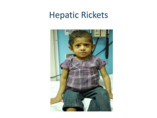 Hepatic Rickets
 
