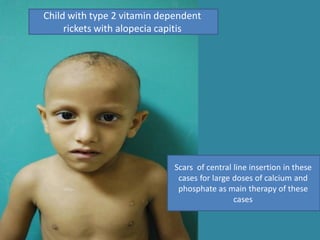 Child with type 2 vitamin dependent
rickets with alopecia capitis
Scars of central line insertion in these
cases for large doses of calcium and
phosphate as main therapy of these
cases
 