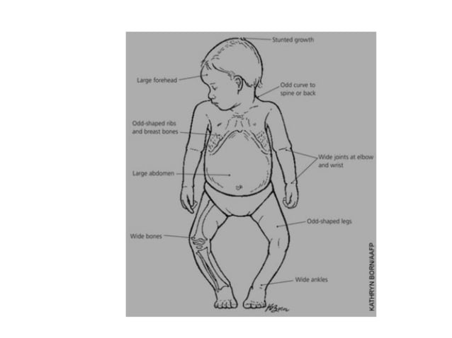 Rickets in children | PDF | Digestive Disorders | Diseases and Conditions