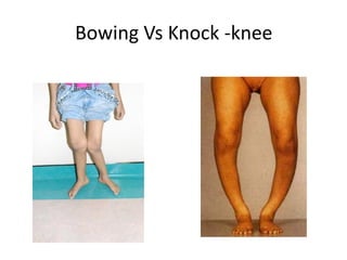 Bowing Vs Knock -knee
 
