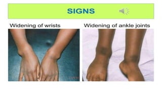 Rickets in children ppt.pptx in pediatric patient | PPTX