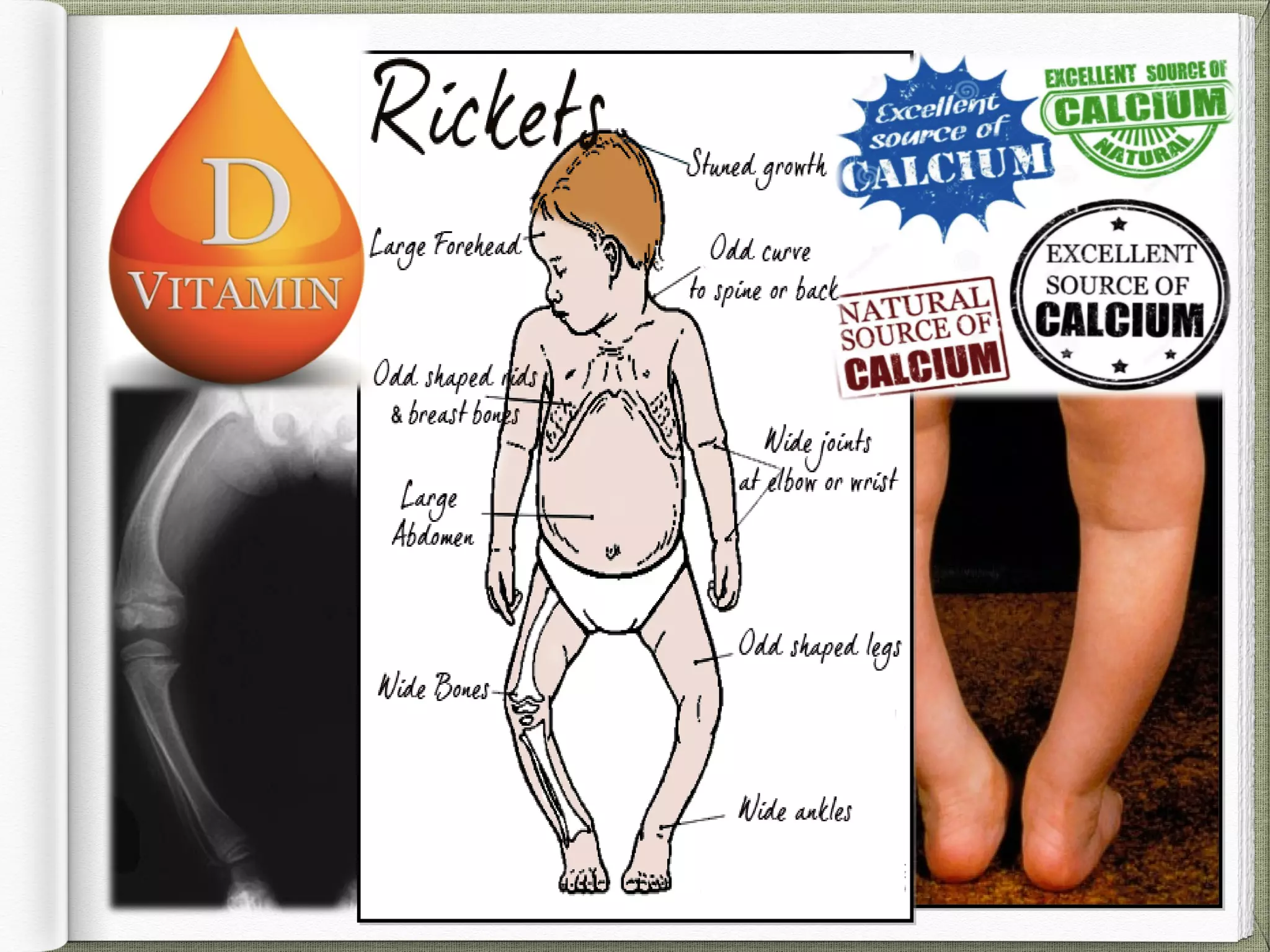Rickets in pregnancy | PPT