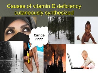 Causes of vitamin D deficiency
cutaneously synthesized

Cance
r???

 
