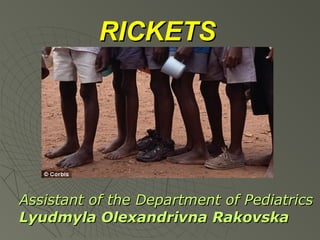 RICKETS

Assistant of the Department of Pediatrics
Lyudmyla Olexandrivna Rakovska

 