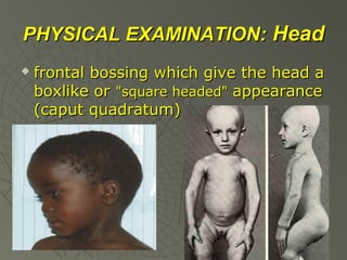 PHYSICAL EXAMINATION: Head


frontal bossing which give the head a
boxlike or "square headed" appearance
(caput quadratum)

 